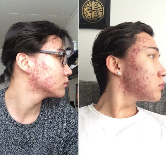 Sau 2 năm khổ vì mụn tấy đỏ, mặt anh chàng này đã thay đổi bất ngờ kể từ khi chuyển sang dưỡng da kiểu Hàn - Ảnh 2.