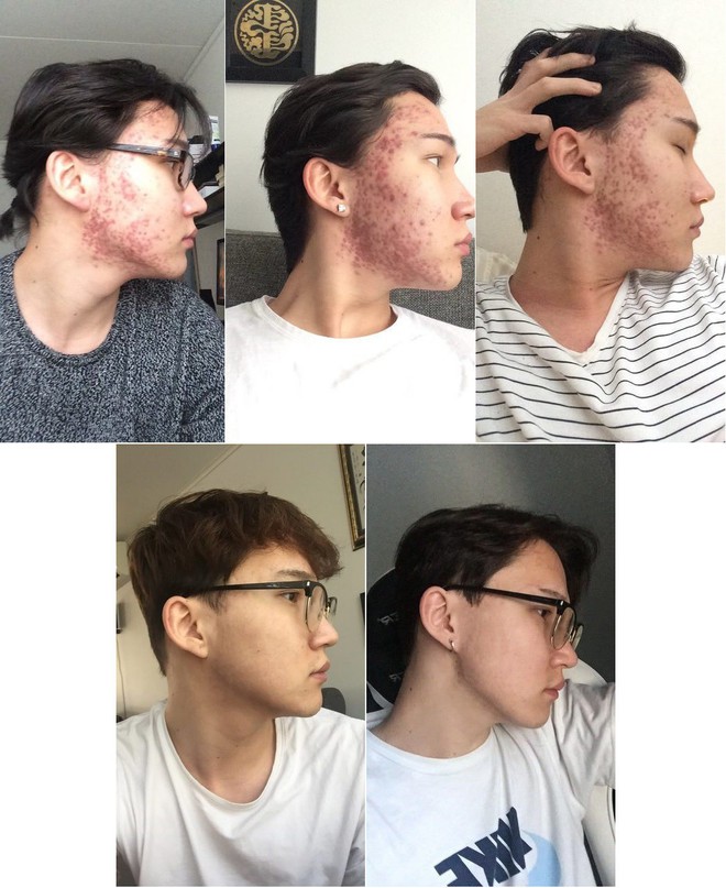 Sau 2 năm khổ vì mụn tấy đỏ, mặt anh chàng này đã thay đổi bất ngờ kể từ khi chuyển sang dưỡng da kiểu Hàn - Ảnh 3.