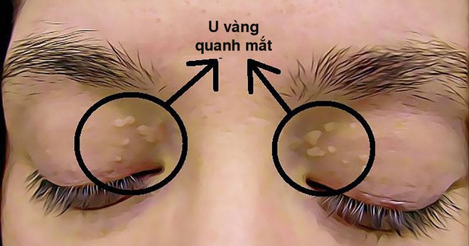 Những nốt màu vàng quanh mắt không chỉ làm bạn xấu mà còn cảnh báo nhiều nguy cơ bệnh - làm sao để loại bỏ chúng? - Ảnh 2.