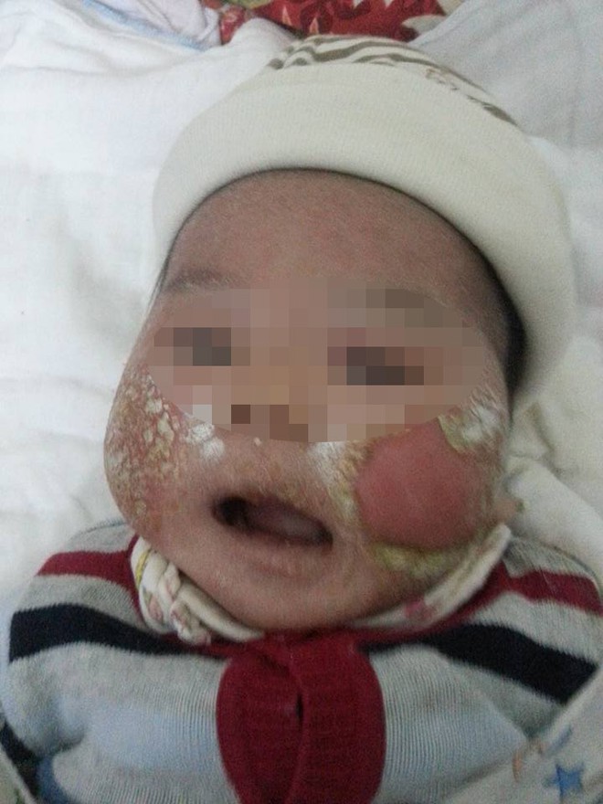 Xót xa em bé 3 tháng tuổi viêm da bội nhiễm, loét hết mặt vì tắm lá - Ảnh 3.