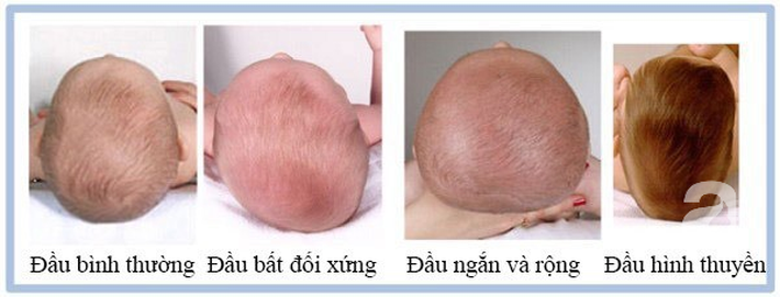 Hội chứng đầu phẳng ở trẻ sơ sinh và những cách phòng ngừa tưởng không dễ mà hóa ra là dễ không tưởng - Ảnh 2.