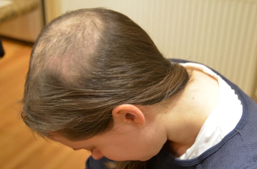 Rụng tóc nhiều ở nữ tuổi 17 có sao không? Cách khắc phục và phòng ngừa