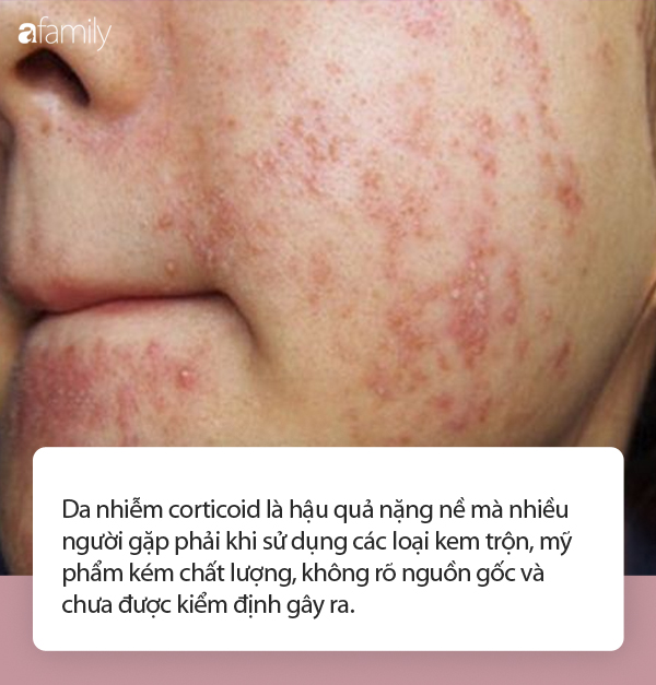 Da nhiễm corticoid: Từ A đến Z nguyên nhân và cách điều trị được bác sĩ da liễu chỉ rõ - Ảnh 1.