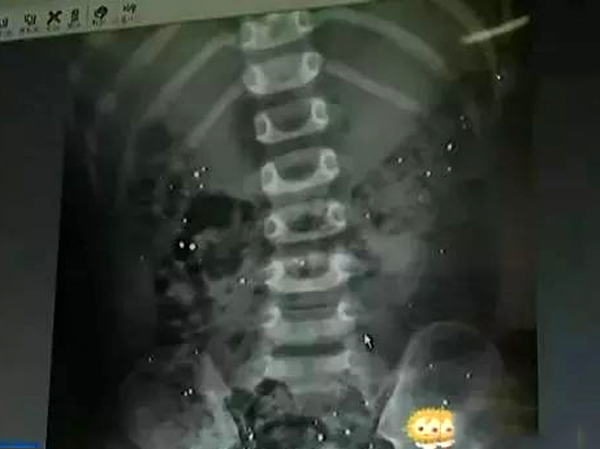 Bé trai 3 tuổi cắn vỡ nhiệt kế thủy ngân, bố mẹ "rùng mình" khi nhìn phim  chụp X-quang