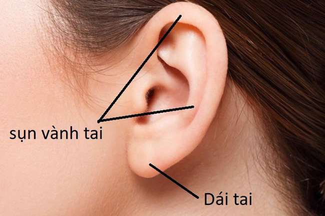 Sẹo đùn kín tai sau khi nâng mũi bằng sụn tai, nhiều chị em nhìn kinh hãi nhưng nhận định của chuyên gia mới đáng để tâm! - Ảnh 5.