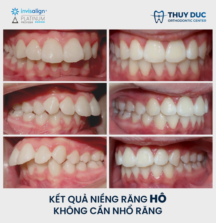 4 điều ba mẹ cần làm nếu muốn con niềng không phải nhổ răng - Ảnh 3. 4 điều ba mẹ cần làm nếu muốn con niềng không phải nhổ răng - Ảnh 3.