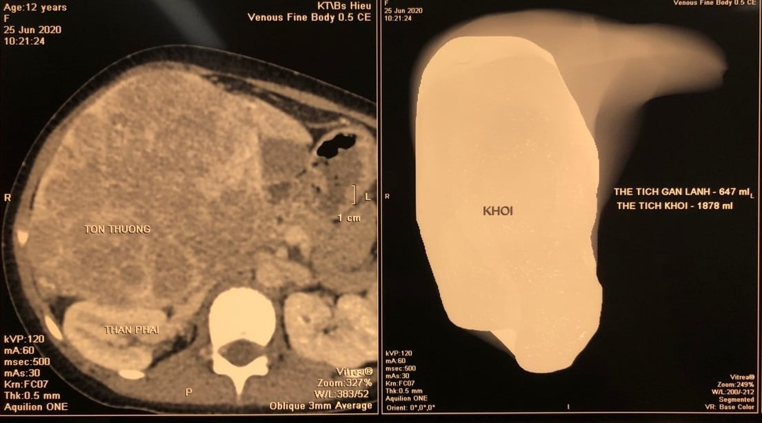 Vào viện vì bụng to bất thường, bé 12 tuổi được chẩn đoán... ung thư gan - Ảnh 1.