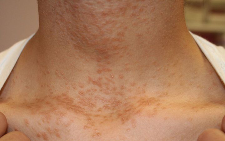 4 dấu hiệu bệnh ung thư xuất hiện ở cổ bạn cần chú ý