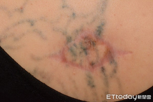 Xuất hiện khối u lạ trên hình xăm, người phụ nữ được chẩn đoán mắc bệnh ung thư da - Ảnh 4.