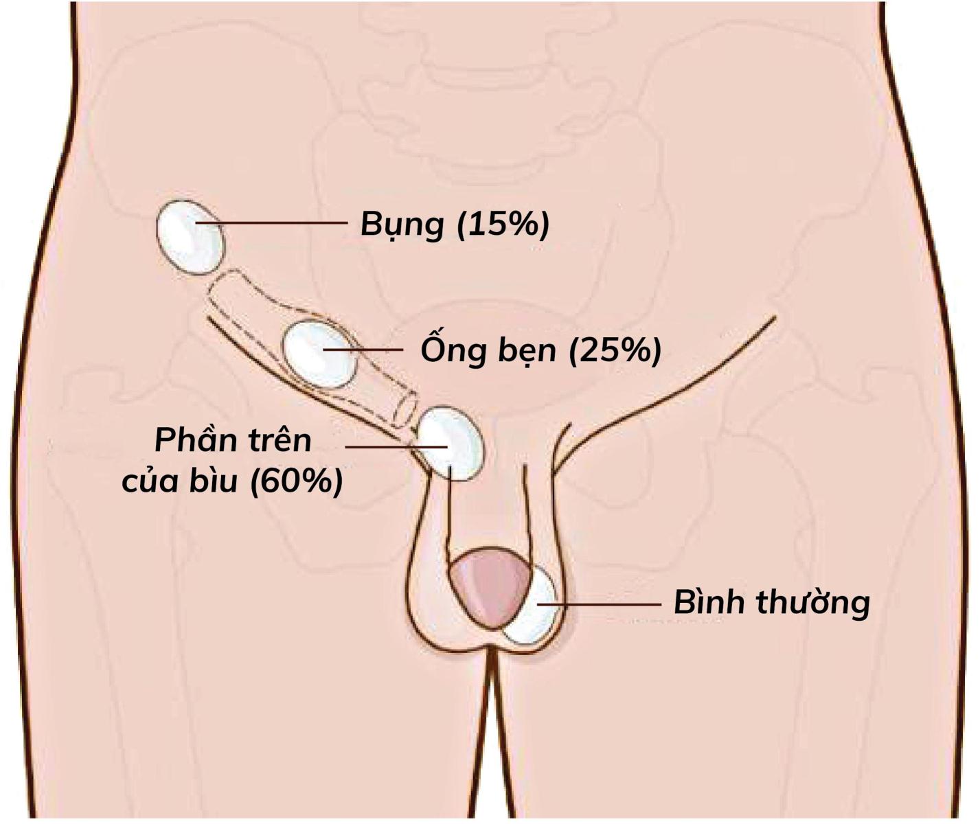 Ẩn tinh hoàn trẻ em – Hành trình đi tìm “hòn ngọc” cho bé phát triển bình thường - Ảnh 1.