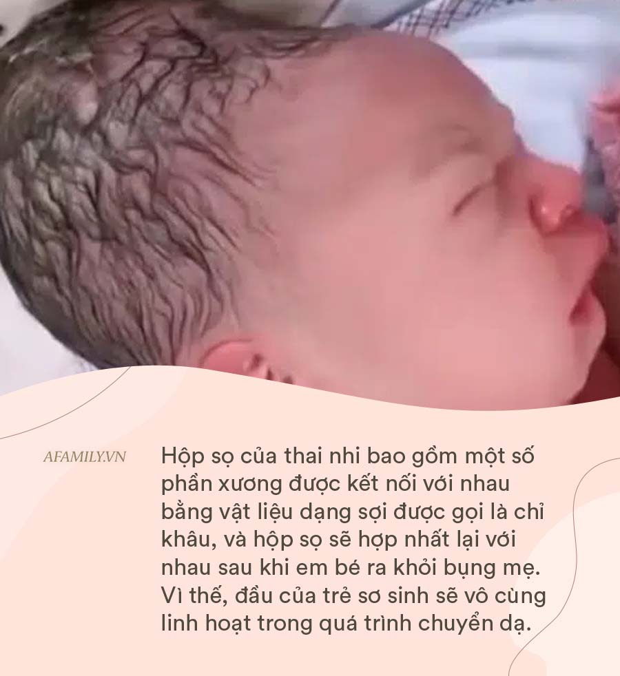 Kinh ngạc với hình ảnh MRI cho thấy đầu của em bé đã "biến dạng" như thế nào khi mẹ sinh thường - Ảnh 5. Kinh ngạc với hình ảnh MRI cho thấy đầu của em bé đã "biến dạng" như thế nào khi mẹ sinh thường - Ảnh 4.