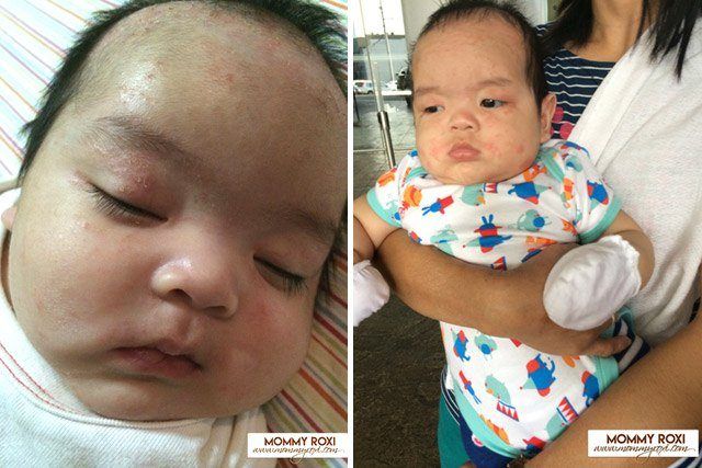 Xót xa cậu bé bị bệnh chàm da “tấn công” ngay từ khi mới 3 tháng tuổi và hành trình 3 năm chữa bệnh vất vả - Ảnh 1.