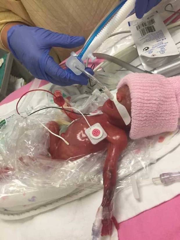 Bị vỡ ối ở tuần 22, bác sĩ chẩn đoán thai đôi trong bụng sẽ chết khi sinh ra, bà mẹ quyết định làm điều không tưởng để cứu các con - Ảnh 5.