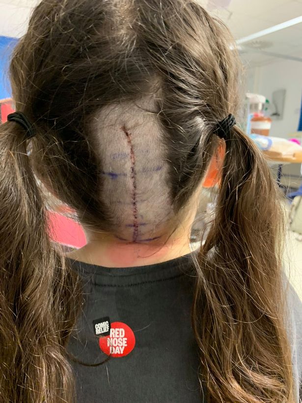 2 năm không đi kiểm tra mắt, bé gái 8 tuổi bất ngờ bị phát hiện có khối u trong não - Ảnh 3.