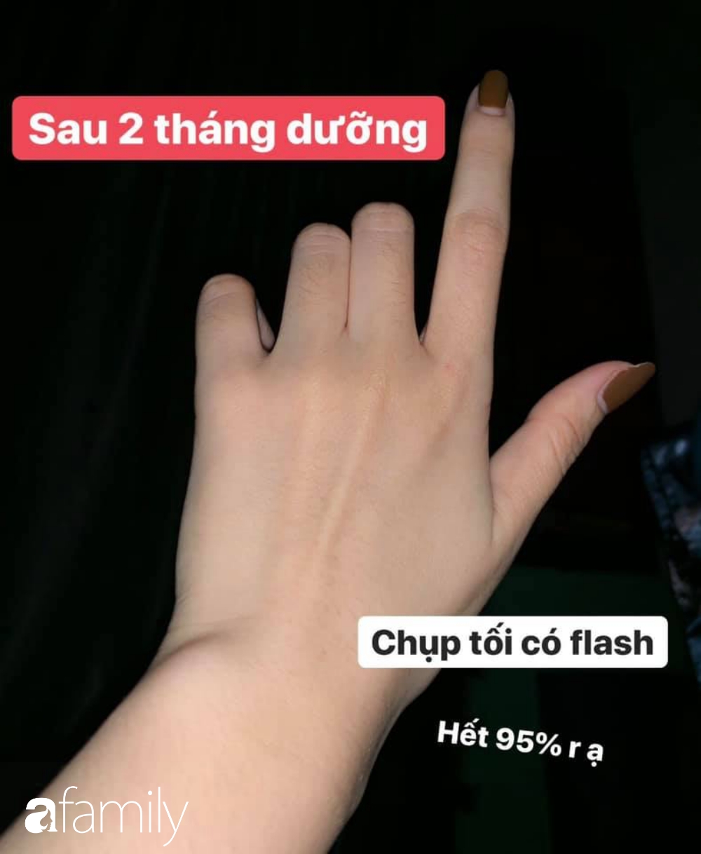 Tự chữa khỏi 95% đốm nâu ở tay, cô nàng này bày sẵn 4 kinh nghiệm và 2 tuýp kem bôi để các chị em học theo  - Ảnh 3.