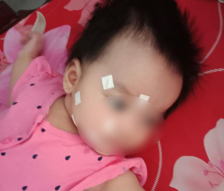 Bé 4 tháng tuổi ở Đồng Nai bị liệt dây thần kinh số 7 vì ra vào ...