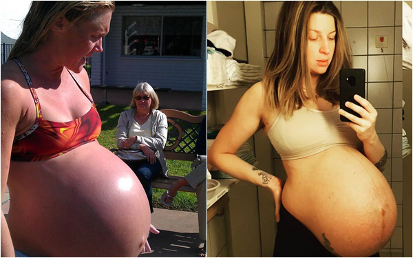 Hình ảnh bụng bầu mang đa thai khiến các mẹ nhìn thôi cũng thấy nặng nề, xót xa
