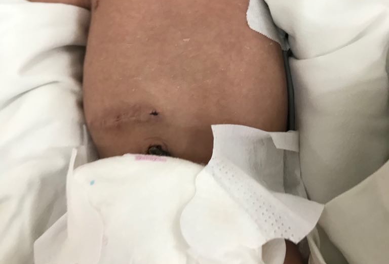 Căng não cứu sống bé sơ sinh bị vón cục sữa trong ổ bụng, sưng ruột non vì tình trạng nguy hiểm này - Ảnh 2. Căng não cứu sống bé sơ sinh bị vón cục sữa trong ổ bụng, sưng ruột non vì tình trạng nguy hiểm này - Ảnh 2.