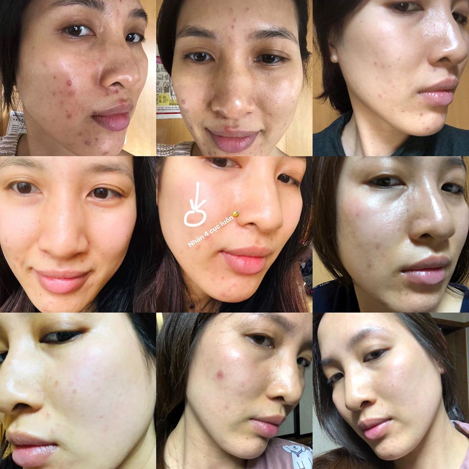 Ngo&agrave;i 30 tuổi bị mụn chi ch&iacute;t c&ograve;n n&aacute;m da do l&atilde;o h&oacute;a, c&ocirc; n&agrave;ng 33 tuổi đ&atilde; phải tự "chữa trị" suốt 2 năm trời, nguy&ecirc;n nh&acirc;n g&acirc;y mụn lại l&agrave; th&oacute;i quen chị em n&agrave;o cũng mắc phải - Ảnh 1.