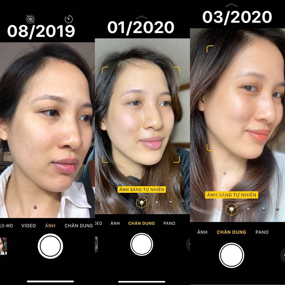 Ngo&agrave;i 30 tuổi bị mụn chi ch&iacute;t c&ograve;n n&aacute;m da do l&atilde;o h&oacute;a, c&ocirc; n&agrave;ng 33 tuổi đ&atilde; phải tự "chữa trị" suốt 2 năm trời, nguy&ecirc;n nh&acirc;n g&acirc;y mụn lại l&agrave; th&oacute;i quen chị em n&agrave;o cũng mắc phải - Ảnh 8.