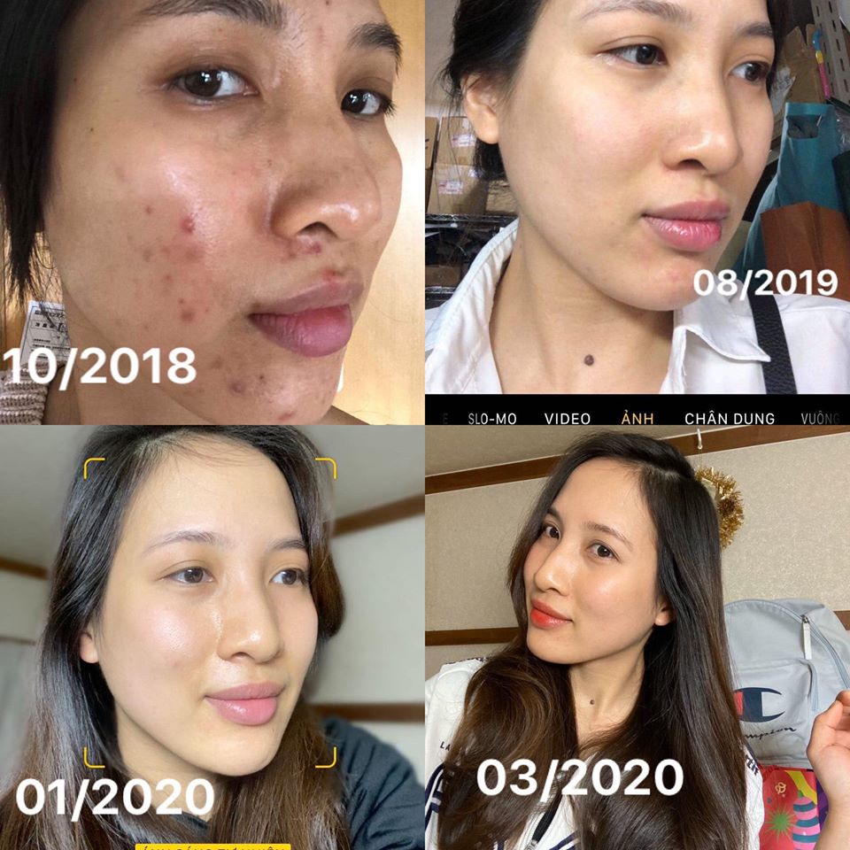 Ngo&agrave;i 30 tuổi bị mụn chi ch&iacute;t c&ograve;n n&aacute;m da do l&atilde;o h&oacute;a, c&ocirc; n&agrave;ng 33 tuổi đ&atilde; phải tự "chữa trị" suốt 2 năm trời, nguy&ecirc;n nh&acirc;n g&acirc;y mụn lại l&agrave; th&oacute;i quen chị em n&agrave;o cũng mắc phải - Ảnh 3.