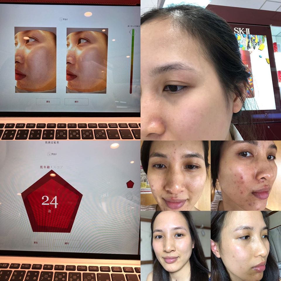 Ngo&agrave;i 30 tuổi bị mụn chi ch&iacute;t c&ograve;n n&aacute;m da do l&atilde;o h&oacute;a, c&ocirc; n&agrave;ng 33 tuổi đ&atilde; phải tự "chữa trị" suốt 2 năm trời, nguy&ecirc;n nh&acirc;n g&acirc;y mụn lại l&agrave; th&oacute;i quen chị em n&agrave;o cũng mắc phải - Ảnh 7.