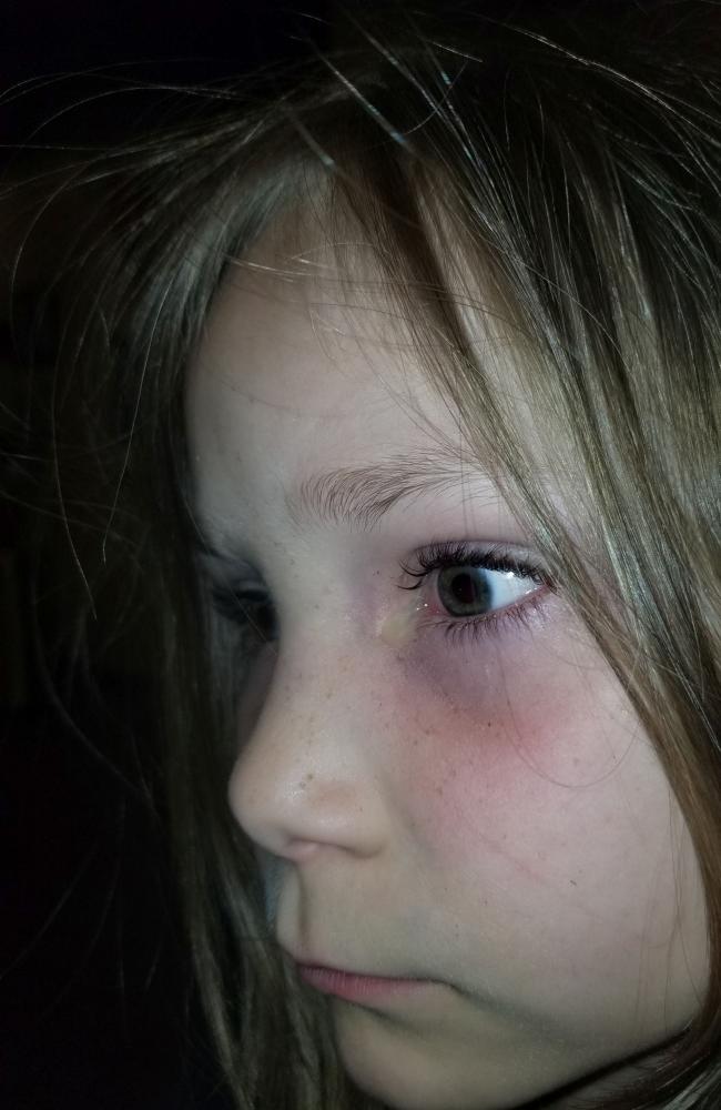Con gái khóc giữa đêm than mắt bỏng rát, mẹ đưa đi cấp cứu thì rùng mình khi thấy một con côn trùng rơi ra khỏi mắt đứa trẻ  - Ảnh 2.