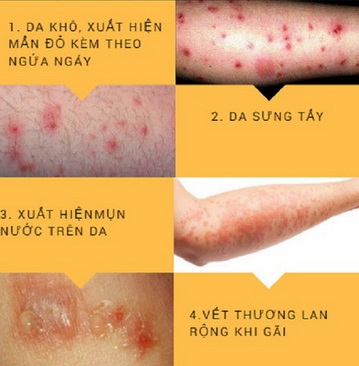 Điểm mặt bệnh về da thường gặp vào mùa hè - Ảnh 1.