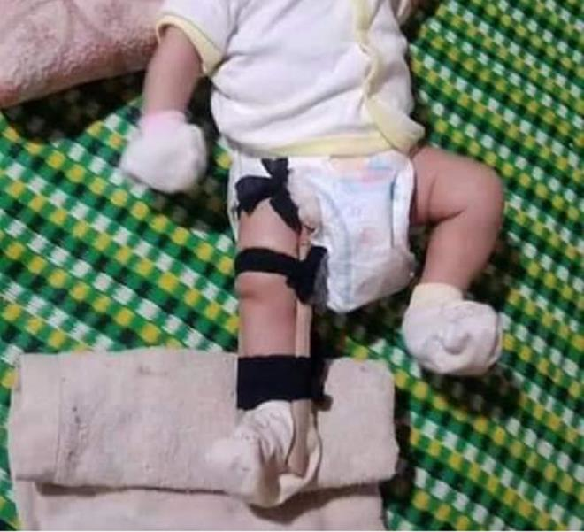 Điều tra thông tin bé 2 tháng tuổi bị cha đẻ đánh gãy chân - Ảnh 1.