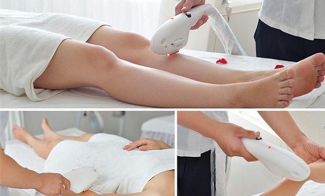 Nhiều lông tay, lông chân khiến chị em thấy thật xấu xí, bác sĩ chỉ ra 2 nhóm các phương pháp tẩy lông, triệt lông cho chị em lựa chọn - Ảnh 3. Nhiều lông tay, lông chân khiến chị em thấy thật xấu xí, bác sĩ chỉ ra 2 nhóm các phương pháp tẩy lông, triệt lông cho chị em lựa chọn - Ảnh 3.