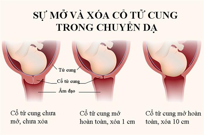 Cổ tử cung mở 2 ngón tay: Dấu hiệu và quá trình chuyển dạ