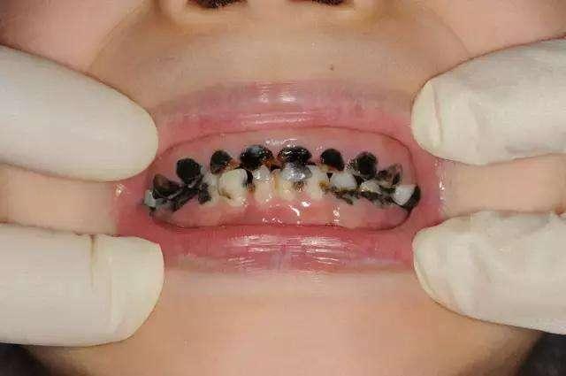 Trẻ có 4 thói quen này bố mẹ cần thay đổi ngay, nó sẽ hủy hoại hàm răng của bé - Ảnh 1.