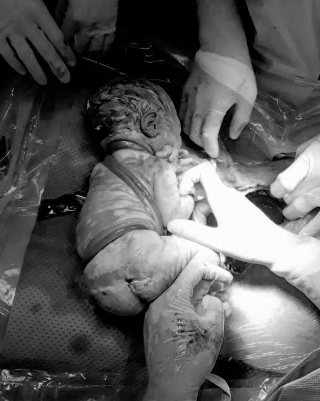 Hiếm gặp: Một em bé chào đời với 6 vòng vòng dây rốn quấn chặt từ cổ chéo xuống bụng, bác sĩ khẳng định quá may mắn - Ảnh 3.