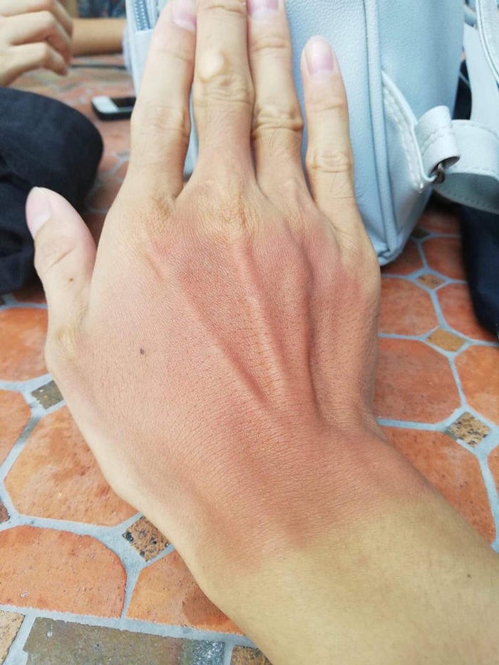 Sốc to&agrave;n tập với những h&igrave;nh ảnh ''ch&aacute;y nắng'' đầu h&egrave; khiến cộng đồng mạng vừa ngỡ ng&agrave;ng vừa lo lắng kh&ocirc;ng th&ocirc;i - Ảnh 9.