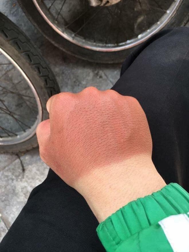 Sốc to&agrave;n tập với những h&igrave;nh ảnh ''ch&aacute;y nắng'' đầu h&egrave; khiến cộng đồng mạng vừa ngỡ ng&agrave;ng vừa lo lắng kh&ocirc;ng th&ocirc;i - Ảnh 2.