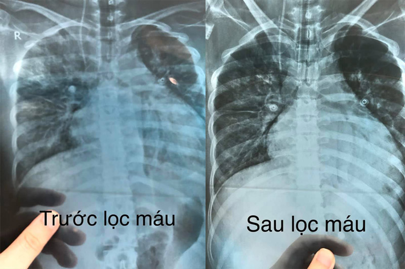 Bệnh viện Nội tiết Nghệ An cứu sống bệnh nhân đái tháo đường có biến chứng nặng - Ảnh 1.