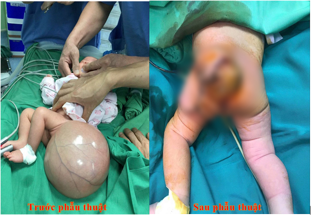 Phẫu thuật thành công cho trẻ sơ sinh bị bệnh thoát vị màng não tủy hiếm gặp  - Ảnh 1.