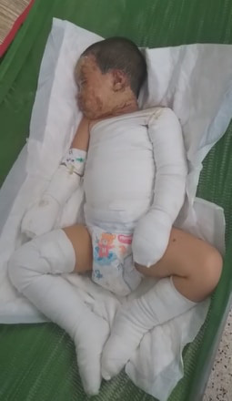 Một nhóm người ném bom xăng rồi ngăn không cho người dân chữa cháy, hai đứa trẻ bị bỏng nặng - Ảnh 5. Một nhóm người ném bom xăng rồi ngăn không cho người dân chữa cháy, hai đứa trẻ bị bỏng nặng - Ảnh 5.