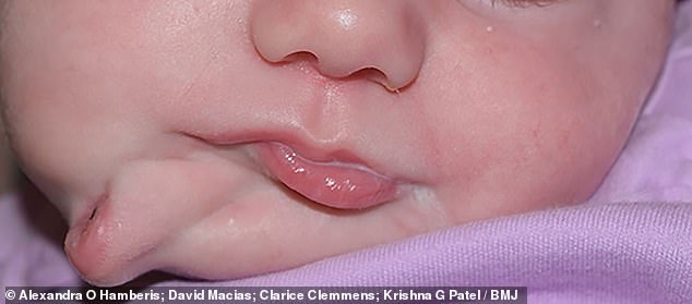 Vừa mới chào đời, bé gái đã khiến các bác sĩ kinh ngạc khi có đến 2 cái miệng trên mặt  - một bệnh lý vô cùng hiếm gặp - Ảnh 1.