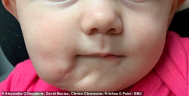 Vừa mới chào đời, bé gái đã khiến các bác sĩ kinh ngạc khi có đến 2 cái miệng trên mặt  - một bệnh lý vô cùng hiếm gặp - Ảnh 3.