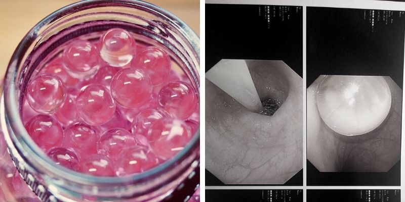 Lời cảnh báo tới cha mẹ về thứ đồ chơi được nhà sản xuất ghi là an toàn, không độc hại nhưng khiến bé trai ăn gì nôn nấy, suýt tắc ruột - Ảnh 4. Lời cảnh báo tới cha mẹ về thứ đồ chơi được nhà sản xuất ghi là an toàn, không độc hại nhưng khiến bé trai ăn gì nôn nấy, suýt tắc ruột - Ảnh 4.