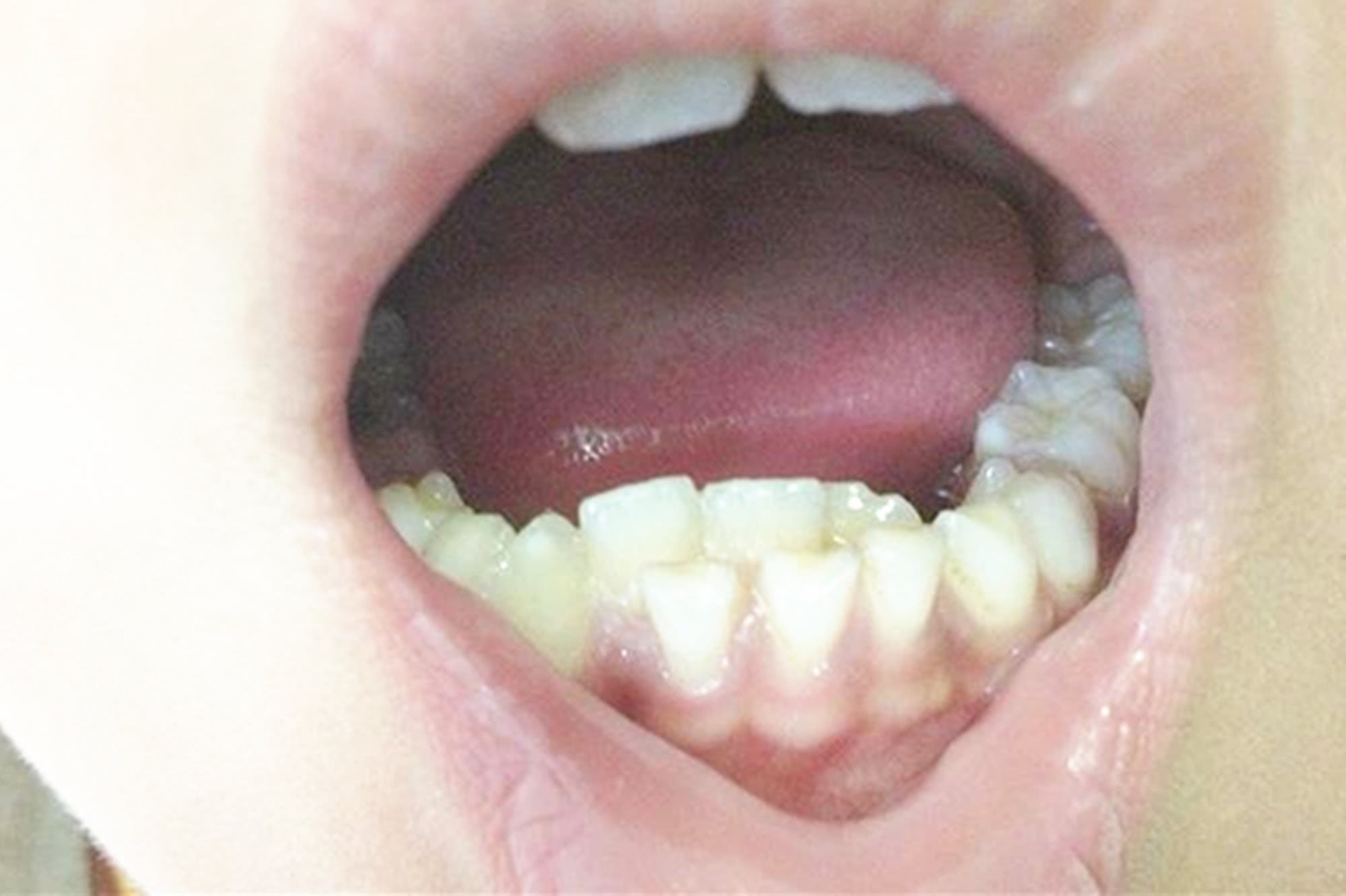 Con có hàm răng như "răng cá mập", bà mẹ hối hận vì nguyên nhân tại mình - Ảnh 3. Con có hàm răng như "răng cá mập", bà mẹ hối hận vì nguyên nhân tại mình - Ảnh 3.