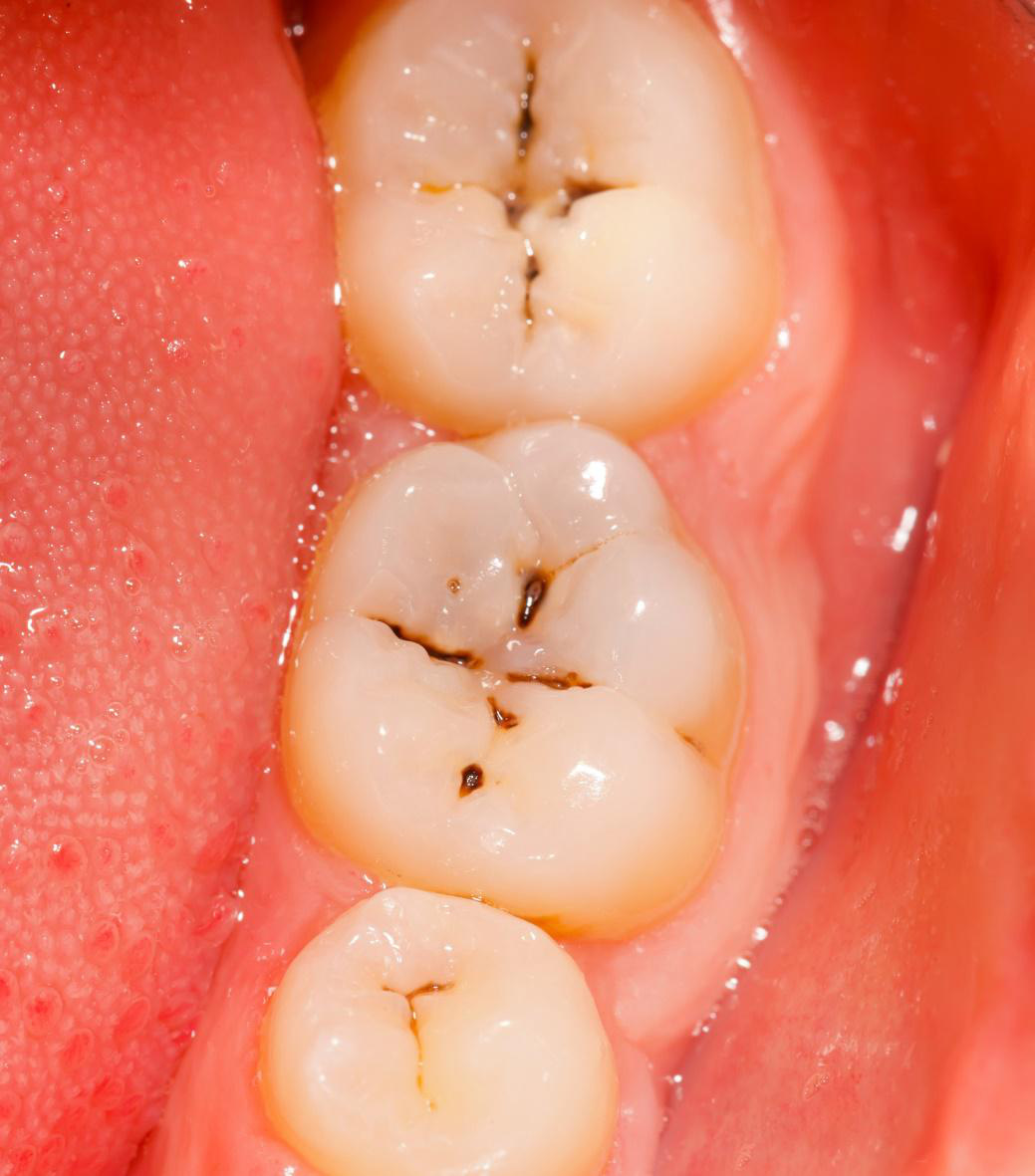 Những bệnh lý răng miệng có thể gây mất răng vĩnh viễn - Ảnh 1.