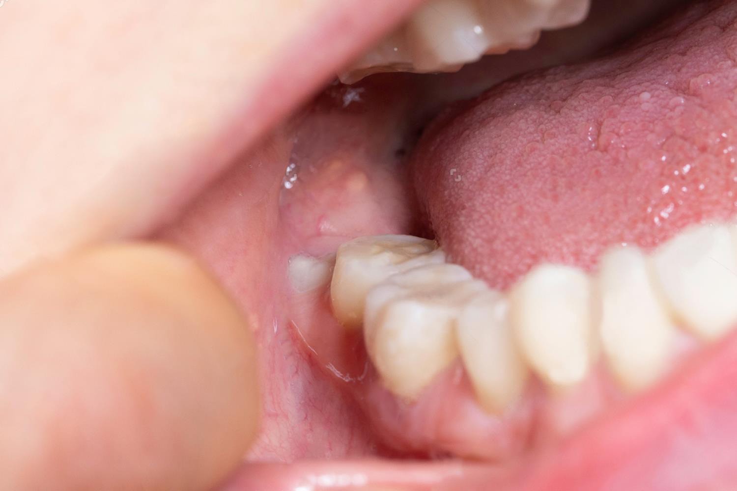 Những bệnh lý răng miệng có thể gây mất răng vĩnh viễn - Ảnh 3. Những bệnh lý răng miệng có thể gây mất răng vĩnh viễn - Ảnh 3.
