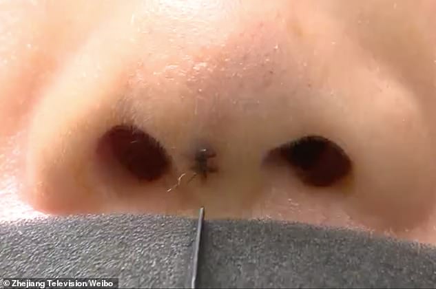 Một người phụ nữ phát hoảng khi thấy thanh silicone được cấy ghép trong mũi bỗng &quot;lấp ló&quot; nơi đầu mũi - Ảnh 2.
