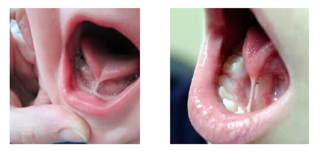 Mỗi ngày có 5-10 bị dính lưỡi phải phẫu thuật, cha mẹ cần biết những dấu hiệu sau - Ảnh 2.