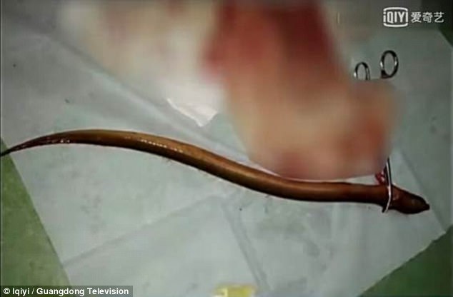 Bị mắc chứng táo bón kéo dài, một người đàn ông đã nhét một con lươn sống dài 40cm vào trực tràng - Ảnh 1.