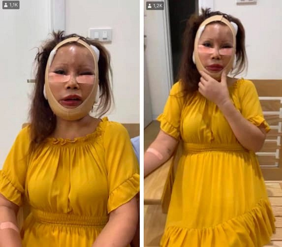 Diện mạo mới của cô dâu 62 tuổi ở Cao Bằng sau 3 ngày khiến dân mạng khiếp vía vì hậu phẫu căng da mặt - Ảnh 2.
