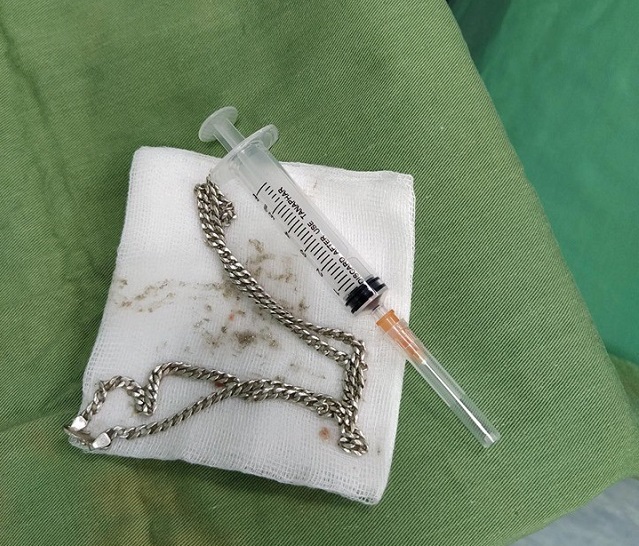 Nghệ An: Sợi dây chuyền bạc nằm trong bụng bé gái 29 tháng tuổi - Ảnh 1.