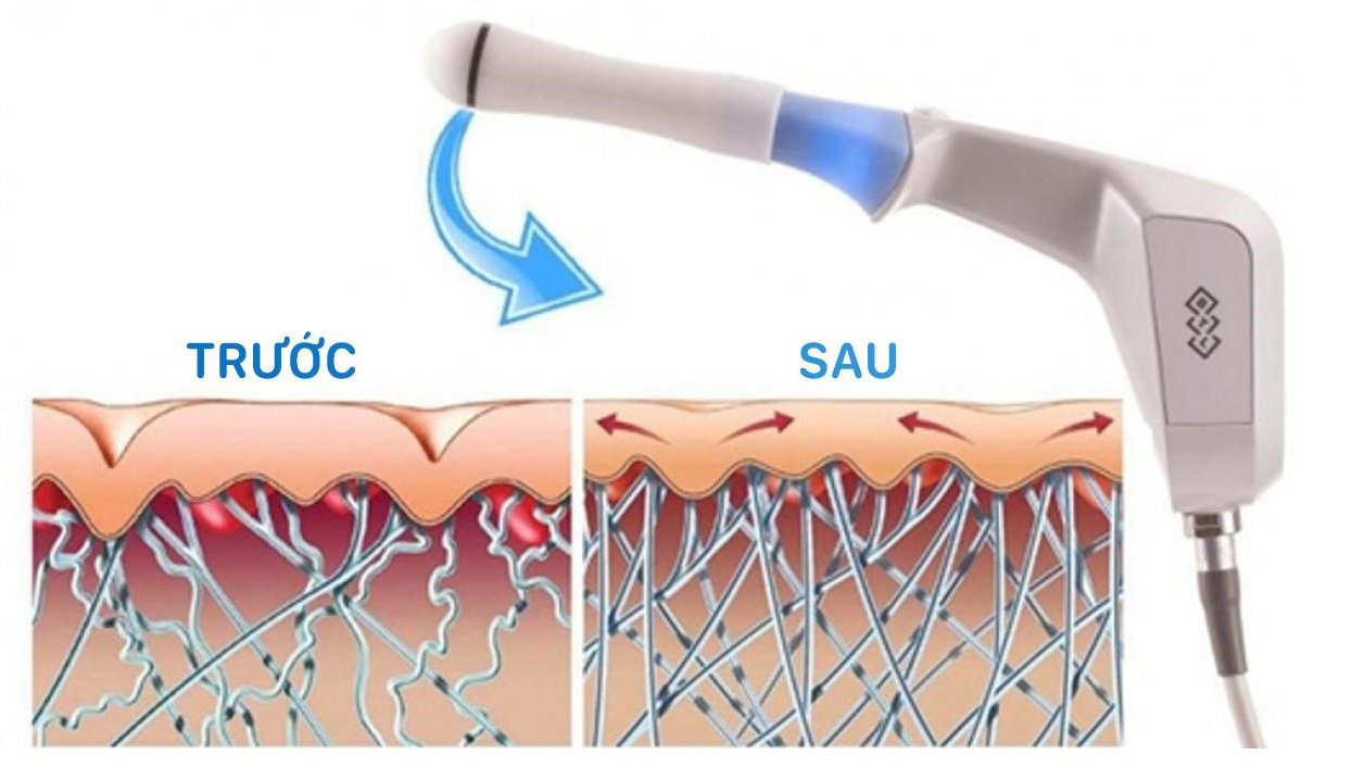 Giải mã cơn sốt trẻ hóa vùng kín 360 độ ngày càng được chị em chú ý - Ảnh 2.